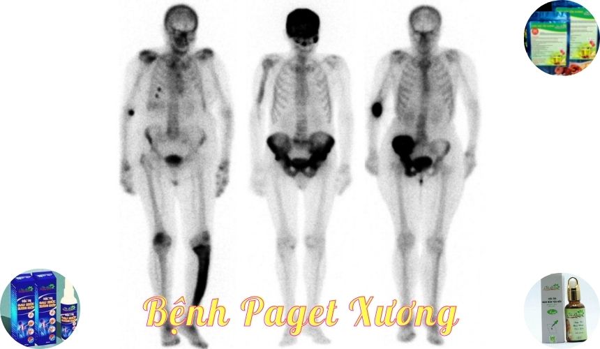 Hình ảnh xạ hình xương bệnh nhân bị paget xương