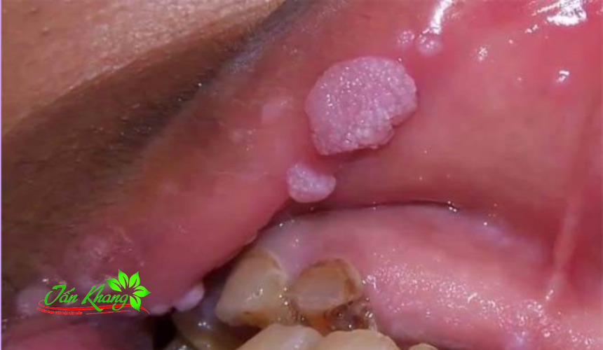 Nguyên nhân và cách điều trị mụn thịt trong miệng hiệu quả nhất