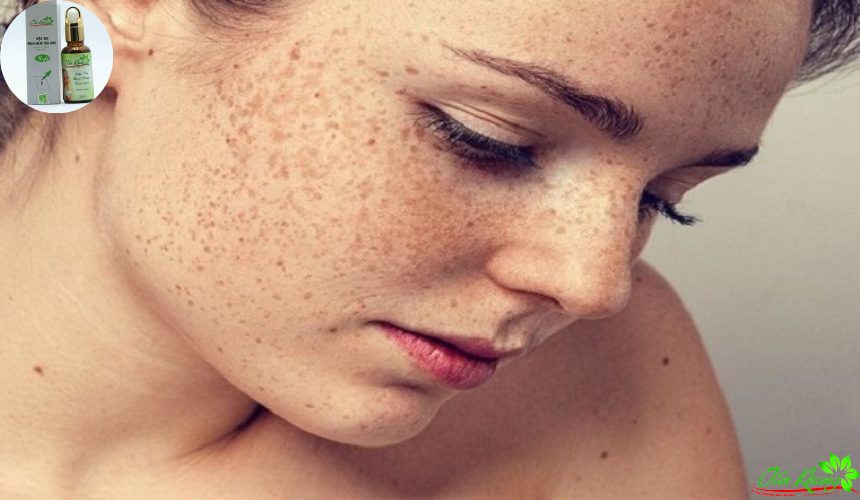 Tăng sắc tố da là dạng rối loạn sắc tố da thường gặp