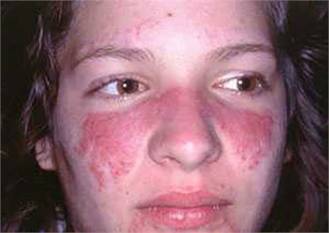 Cách nhận biết bệnh lupus ban đỏ