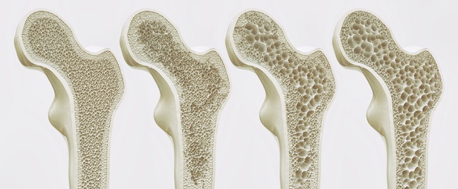 Cách nhận biết bệnh đau nhức xương khớp, nguyên nhân và cách chữa trị bệnh đau nhức xương khớp