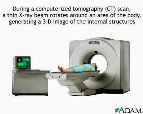 Chụp CT Scan Rủi Ro Nhiễm Phóng Xạ