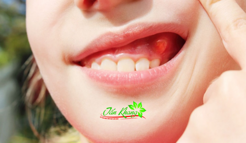 Nguyên nhân và cách điều trị mụn thịt trong miệng hiệu quả nhất