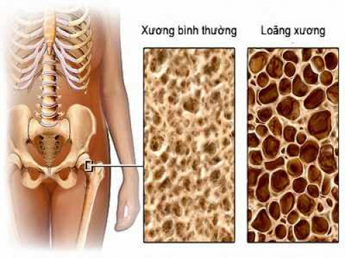 Loãng xương là gì và cách chẩn đoán loãng xương